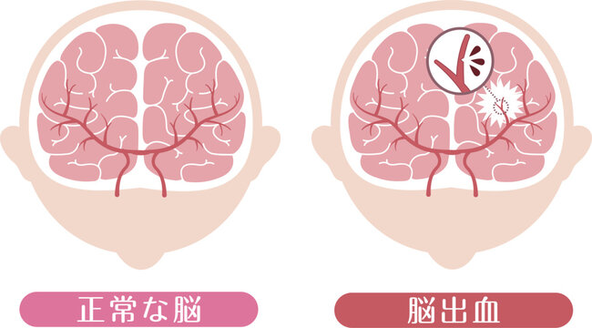 Cerebral hemorrhage comparison with normal brain medical illustration