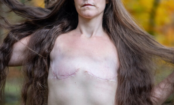 Portrait of a woman with long hair showing the scars of a double mastectomy. Her strength and presence radiate through the image, embracing healing, identity, and body acceptance