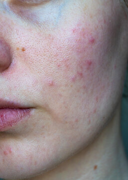 Vertical close up of young woman face with acne, redness and uneven skin texture. Natural skin without makeup. Concept of skincare, dermatology and skin problems.