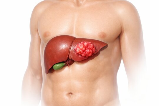 Liver cancer medical illustration showing malignant hepatocellular mass in liver parenchyma in oncology and hepatology concept for diagnosis pathology education and clinical care