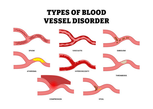 Different types of blood vessel disorder  or vein disorder types set collection. Labeled spasm, vasculitis, embolism, atheroma, hyperviscosity, thrombosis, compression, steal. Circulatory system.