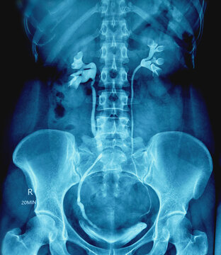 X-ray of human IVU. Right lower ureteric calculus at VUJ with back pressure changes and mild hydroureteronephrosis. Normally excreting both kidneys.