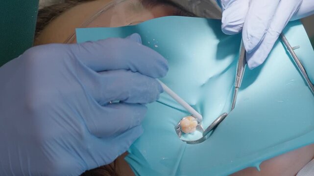 Stomatologist coats prepared child tooth cavity with liquid bonding agent using microbrush. Direct pediatric restorative procedure with blue latex rubber dam isolation technique.