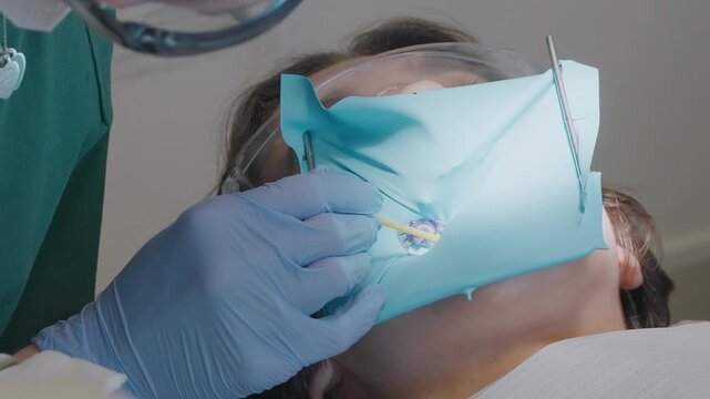 Pediatric dentist uses microbrush to apply blue caries detector dye over the whole visible crown of an isolated kid tooth. Diagnostic step to identify decay under rubber dam.