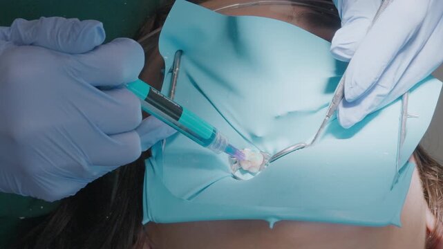 Doctor extrudes blue phosphoric acid etching gel onto child tooth fissures and enamel margins. Chemical preparation step for pediatric composite restoration with blue rubber dam.