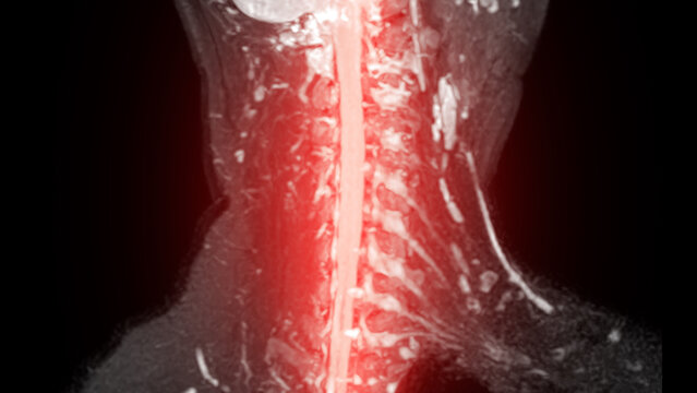 Medical MRI scan showing the cervical spine and brachial plexus.