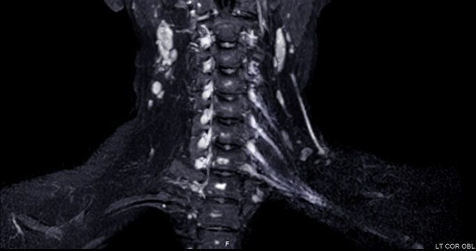 Medical MRI scan showing the cervical spine and brachial plexus.