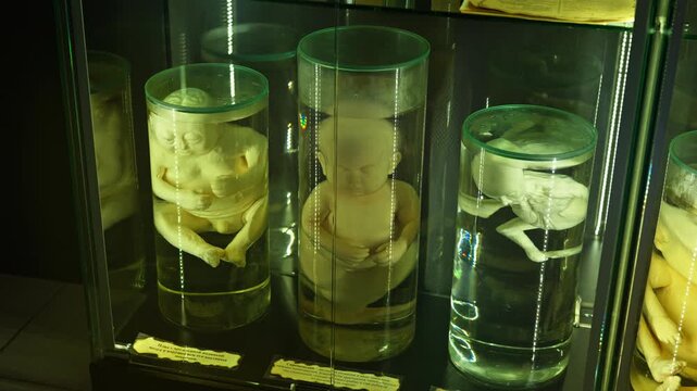 A human infant body with the pathological development of anencephaly in the water.