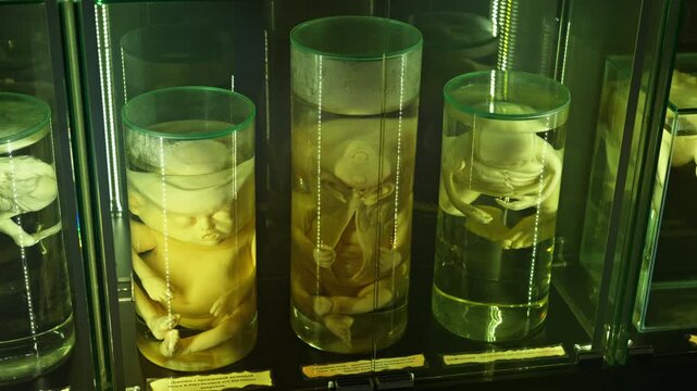 A human infant body with the pathological development of anencephaly in the water.