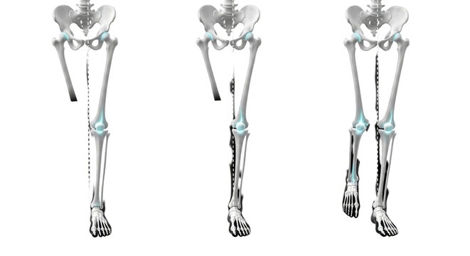 three human leg skeletons demonstrating normal, genu valgus, and genu varus orthopedic alignments with mechanical axis dotted lines on a black background, clinical comparison illustration
