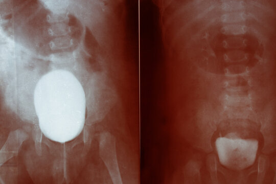 X-ray of a child's pelvis and bladder with contrast for diagnostics, examination of the urinary system