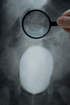 X-ray of a child's pelvis and bladder with contrast for diagnostic purposes