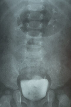 X-ray of a child's pelvis and bladder with contrast for diagnostics, examination of the urinary system