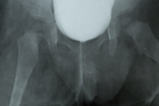 X-ray of a child's pelvis and bladder with contrast for diagnostics, examination of the urinary system