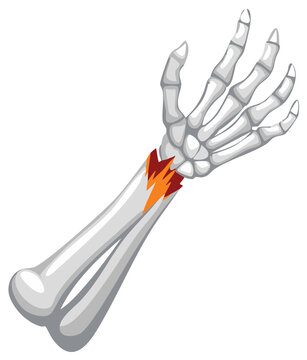 Broken Arm Bone Fracture Illustration, Human Skeleton Injury, Medical Condition Bone Structure, Orthopedic Trauma