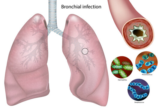Detailed medical illustration of bacterial bronchitis showing human lungs and cross section of inflamed bronchus with mucus accumulation. Pathogenic bacteria Haemophilus, Pneumococcus, Streptococcus