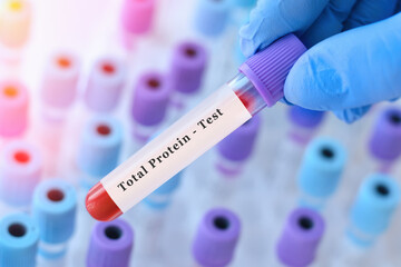 Fototapeta premium Doctor holding total protein blood test tube explaining evaluation of protein balance, nutritional status, liver and kidney function during routine laboratory diagnostics