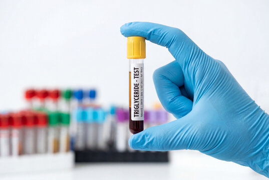 Gloved hand holding a triglyceride test blood sample tube