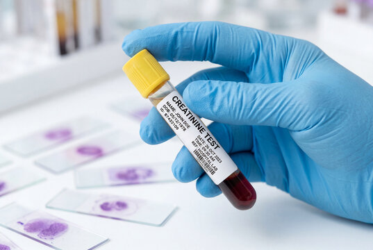 Gloved hand holding a creatinine test blood sample tube