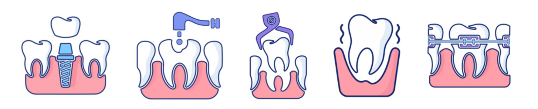 Dental care and stomatology professional procedures dental implant installation, cavity drilling treatment, surgical tooth extraction with forceps, loose tooth symptoms and orthodontic braces for teet