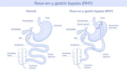 Roux-en-Y gastric bypass. Vector illustration