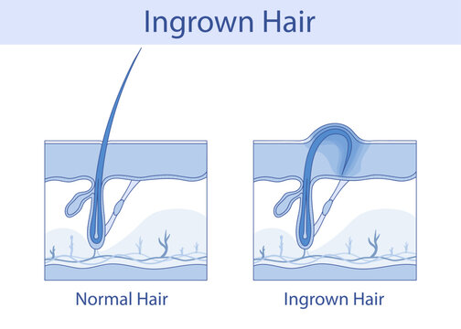 Ingrown hair, hand-drawn anatomical illustration in cartoon style