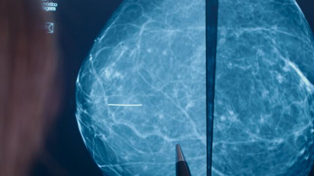 Close-up of a doctor analyzing a mammogram