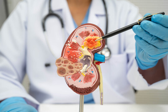 Chronic kidney disease, doctor with model for treatment urinary system, urology, Estimated glomerular filtration rate eGFR.
