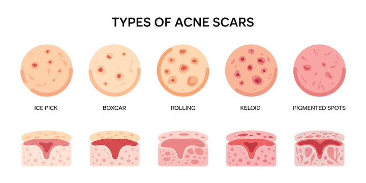 Types of acne scars illustration