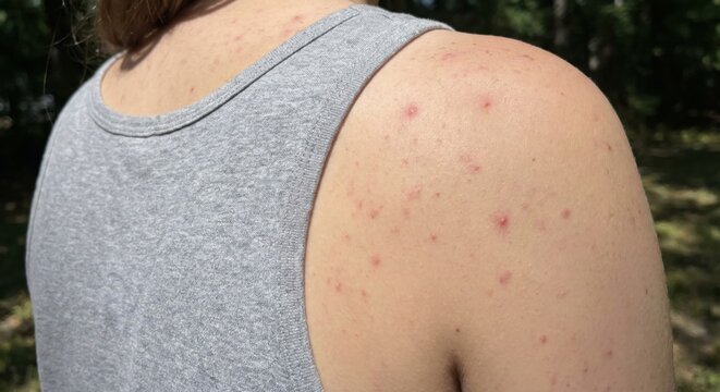 Close-up of body acne on person's shoulder and back
