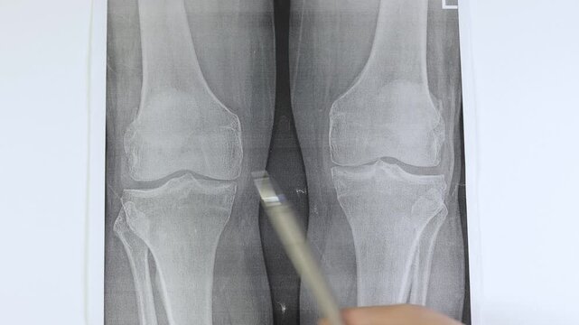 Doctor learn X-ray of knee joint arthritis. Medical scan.