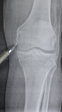 Vertical footage of doctor learn X-ray of knee joint arthritis. Medical scan.