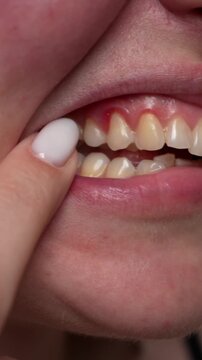 Close up of young woman touching teeth showing tooth pain and gum inflammation. Concept of dental health, sensitivity, oral care and dentistry problems.