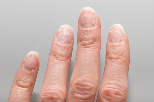 Close-up of damaged natural nails. A natural hand with problematic cuticles and broken nails. Emotional stress. Age-related skin changes. Hand care