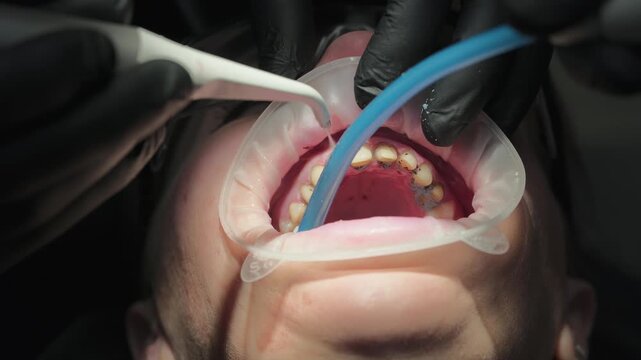 Close-up view of a dental hygienist using an ultrasonic scaler and a suction tube to remove tartar and plaque from a patient's lower teeth during a professional cleaning session