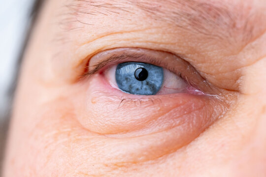 female eye with visible redness, severe swelling, periorbital edema, inflammatory process, allergic, infectious eye condition, ocular inflammation and trauma, ophthalmology blepharitis, conjunctivitis