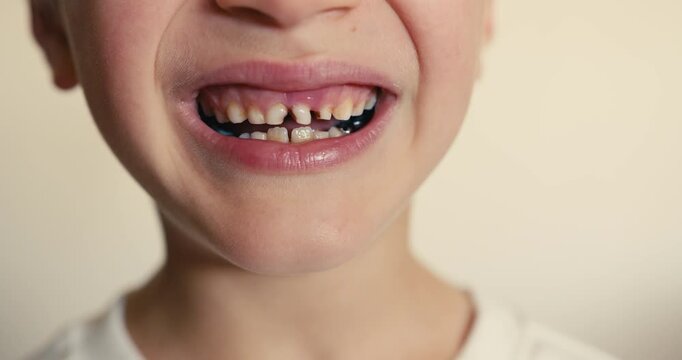 Close-up of a child smile with baby teeth showing plaque and cavities. Children dental hygiene. Dental care.