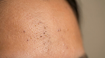 Fototapeta premium Skin Healing Marks Acne Forehead Closeup showing blackhead clusters on face against neutral background
