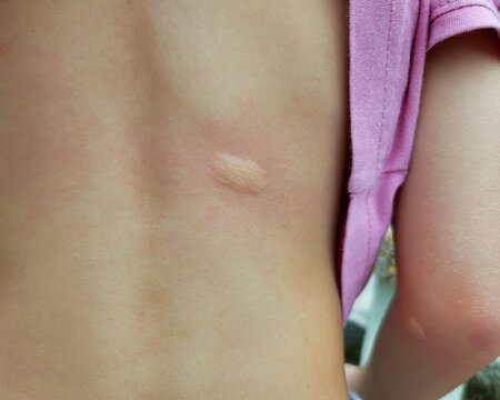 Mosquito bites on a child's back.