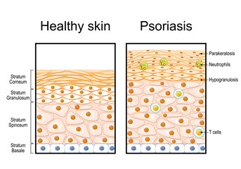 Psoriasis. Comparison of healthy skin epidermis and psoriatic skin structure. 