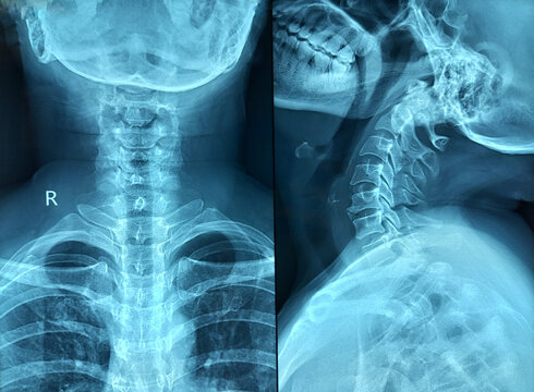 X-ray of human cervical spine. Cervical spondylosis. 