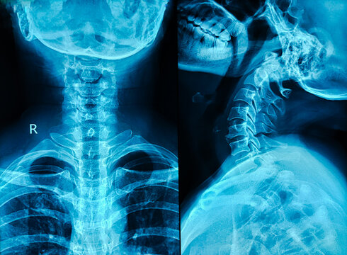 X-ray of human cervical spine. Cervical spondylosis. 