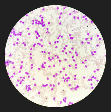 Acute Leukaemia. Acute leukemia on microscopic examination. acute leukemia.