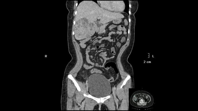 Contrast-enhanced abdominal CT demonstrating a well-defined heterogeneous iso-hypodense lesion in the right hepatic lobe with rim enhancement in arterial and venous phases, thick wall, and clustered a
