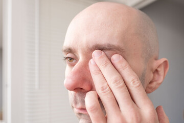 Fototapeta premium man touching area around eye with fingers, looking concerned, vision correction, fatigue, irritation or headache, eye pain, including strain, vision examination, corneal ulcers, acute angle-closure