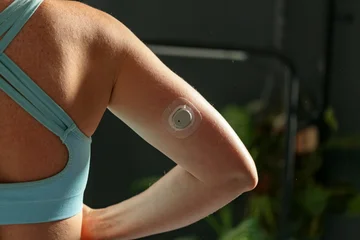 Diabetic young woman with glucose sensor and mobile phone measuring blood sugar level at home © Maksims