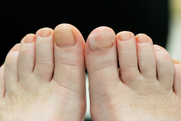Fototapeta premium Reconstructed toe nail alongside opposite big toe nail