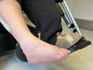 Naklejka premium paralyzed patient’s bare foot, spasticity, hemiplegia, spinal cord injury, Asymmetric footwear, long-term care needs in geriatric, neurologic Velcro-fastened orthopedic shoe, rehabilitation settings