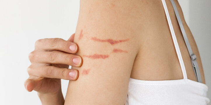 Close-Up of Woman Showing Multiple Red Linear Scratch Marks on Upper Arm and Shoulder &mdash; Female Skin with Visible Wounds, Domestic Violence Awareness, Skin Trauma, Victim Support and Healthcare Medical