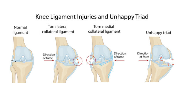 Knee Ligament Injuries and Unhappy Triad
Illustration showing normal knee ligaments, lateral and medial collateral ligament tears, and the classic unhappy triad injury mechanism.